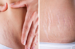Gợi ý sản phẩm điều trị rạn da cho phụ nữ mang thai và sau sinh